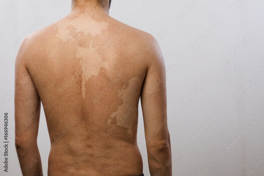 Vitiligo